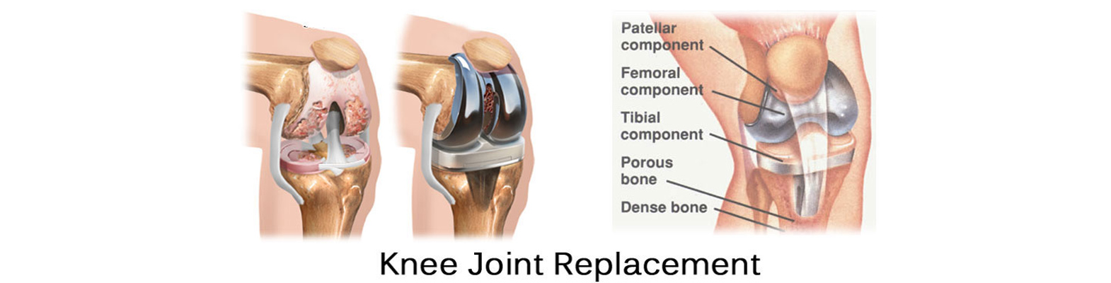 Joint replacement in jaipur
