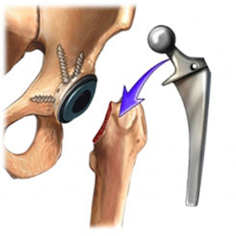 Joint replacement in jaipur