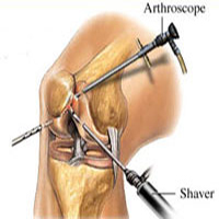 Joint Surgeon in jaipur