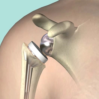 Joint replacement in jaipur